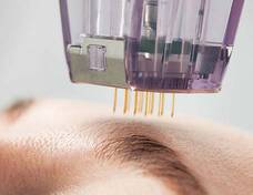 Microneedling