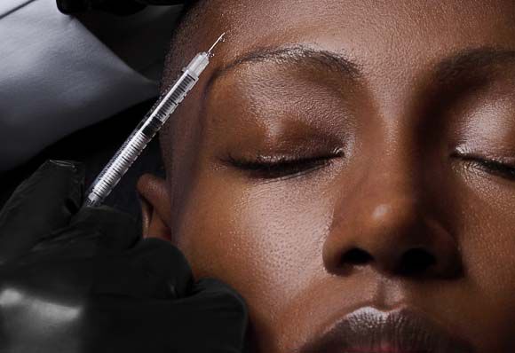 Adult Acne + Scarring