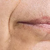 Skin Laxity