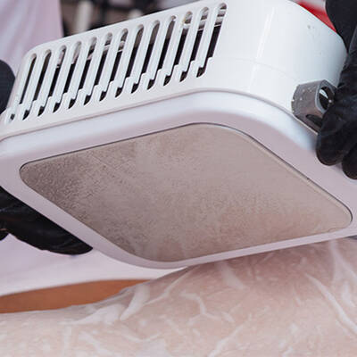 cryolipolysis