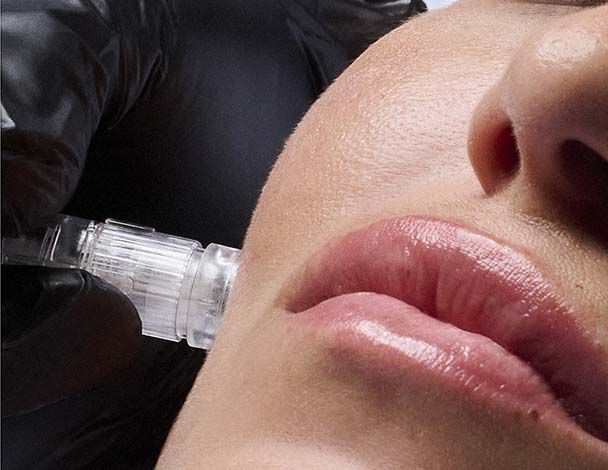 Aquagold Microneedling Image