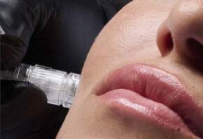 Aquagold Microneedling Image