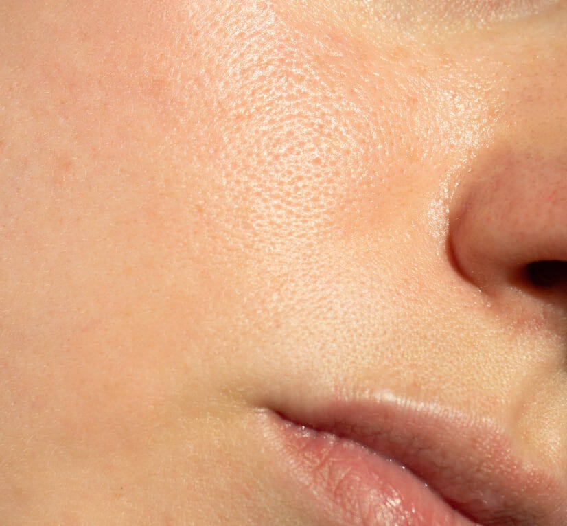 How to prevent and minimize pores