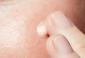 HPR Retinoate image