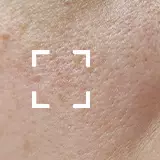 Dehydrated Skin