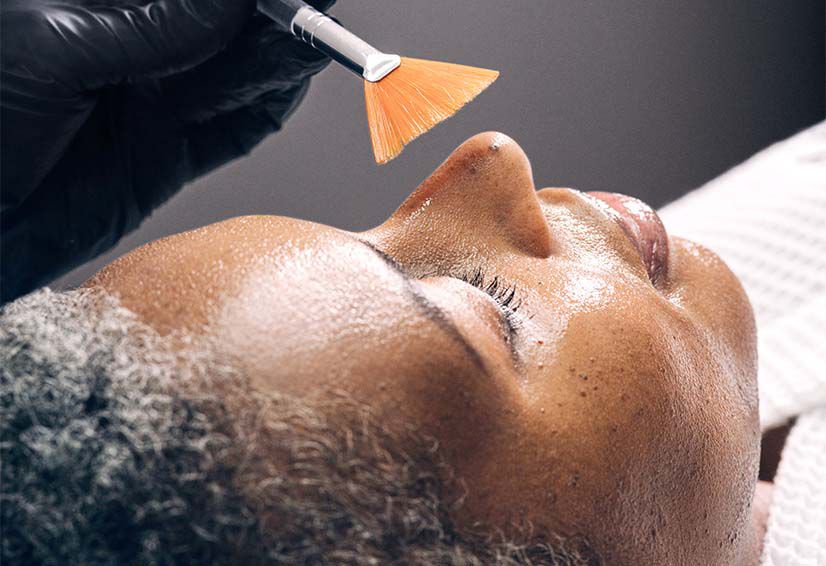 Medium Chemical Peel Image