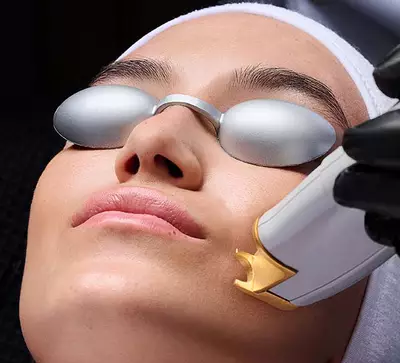 non ablative laser